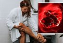 Blood clots: Four skin changes in the arms and legs that are warning signs