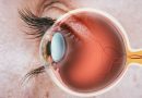 What is Optic Nerve Hypoplasia?